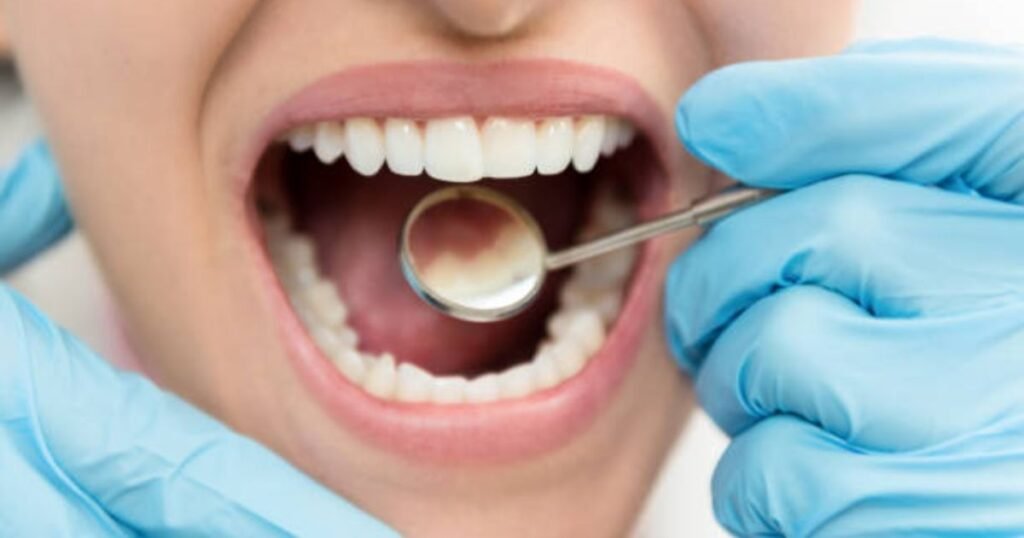 white fillings