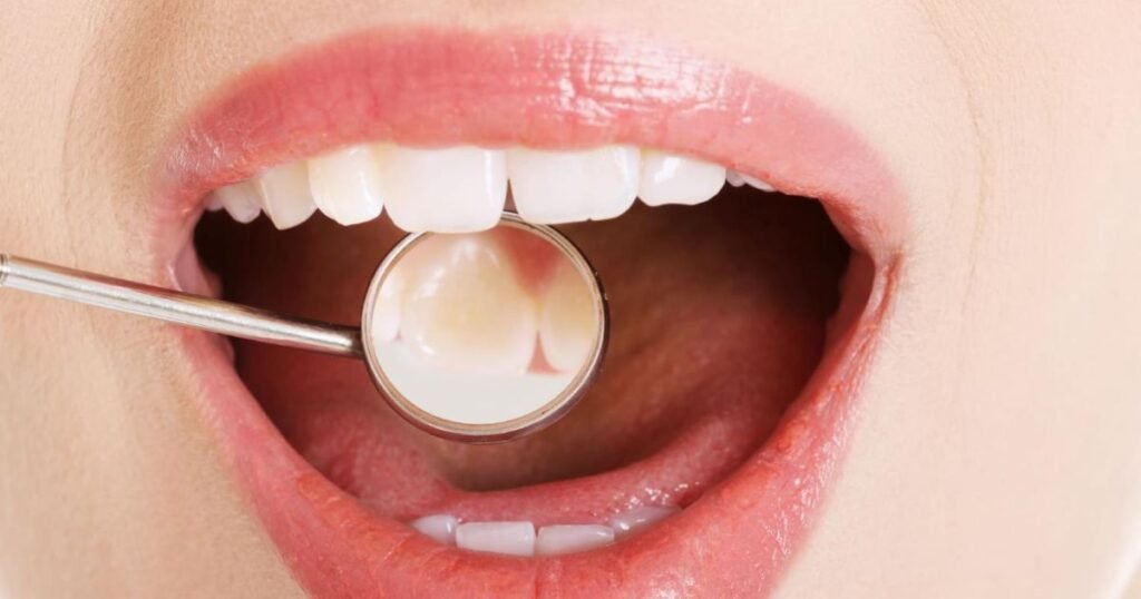 white fillings